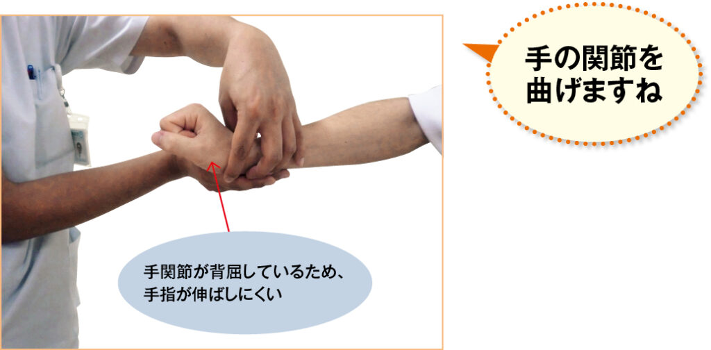 指の拘縮の様子