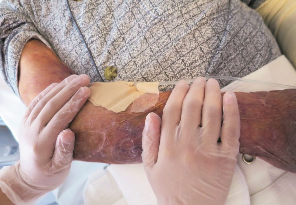 保湿剤の塗布の様子