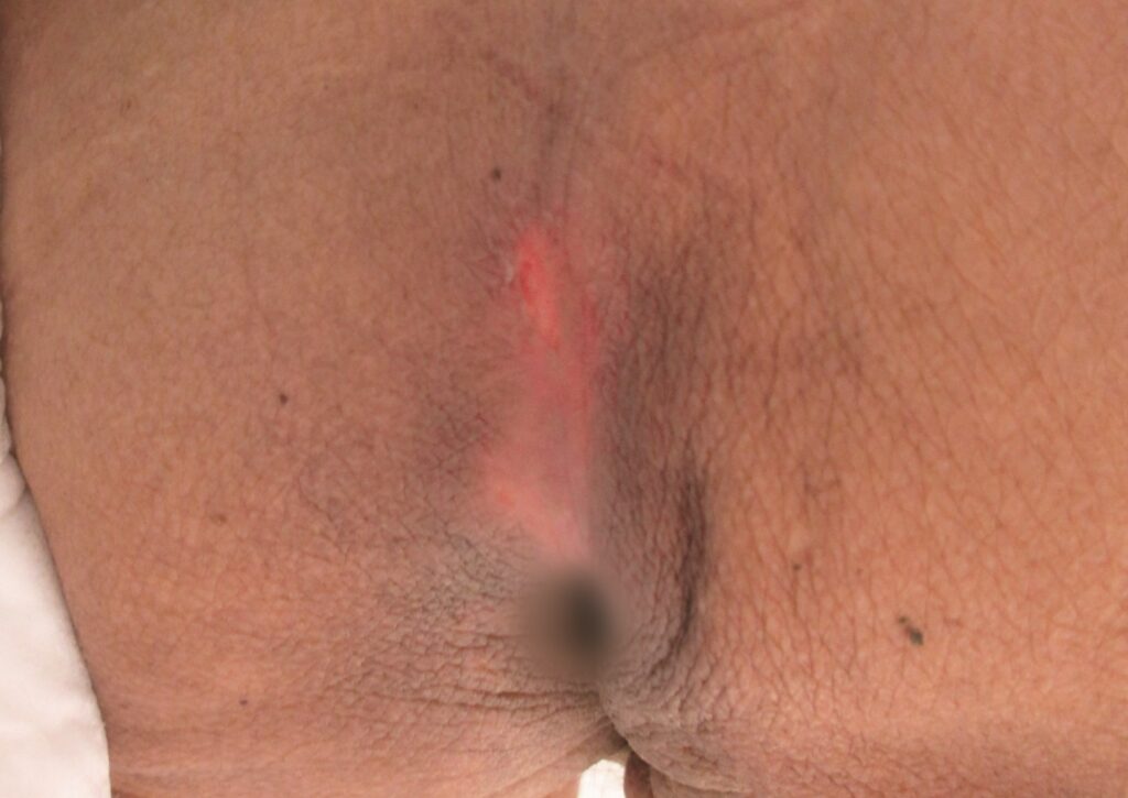 褥瘡の症例写真