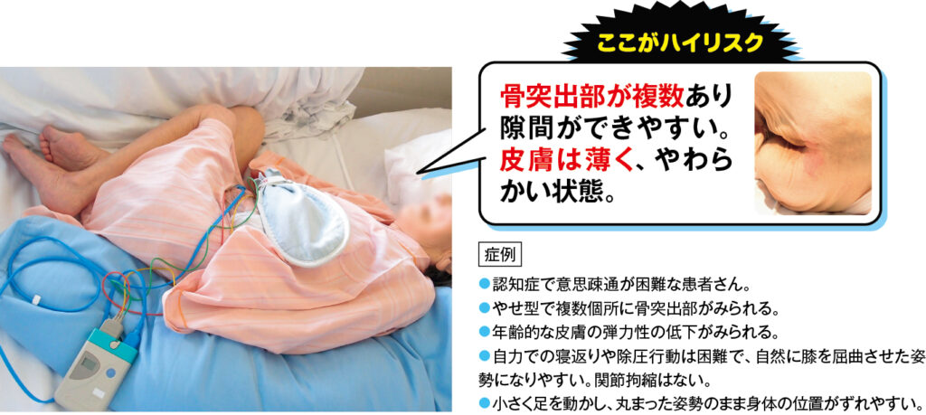 骨突出部が複数