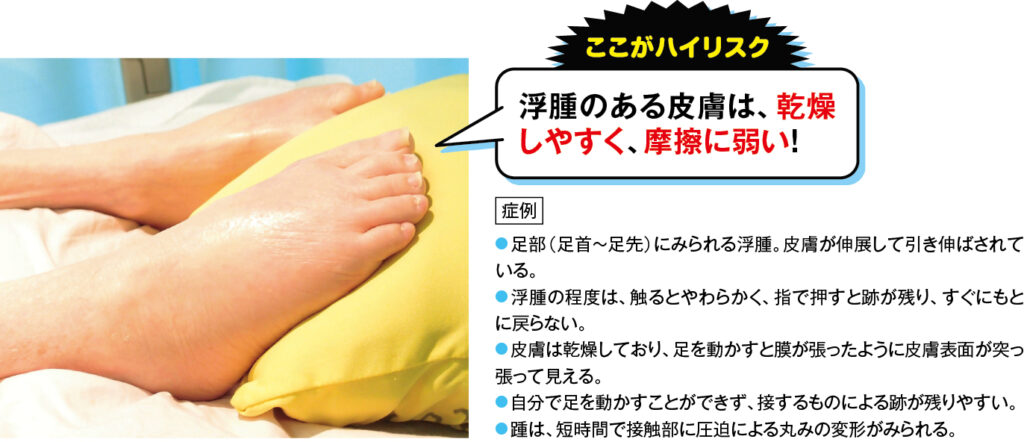 浮腫のある皮膚