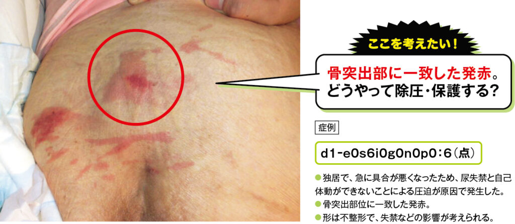 仙骨部に発生したd1褥瘡の症例