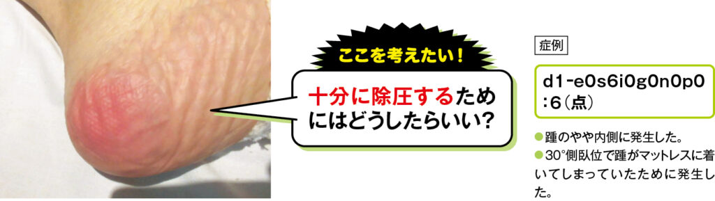 踵部d1褥瘡の症例写真