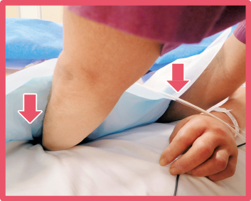 マットレスを押し下げる除圧法