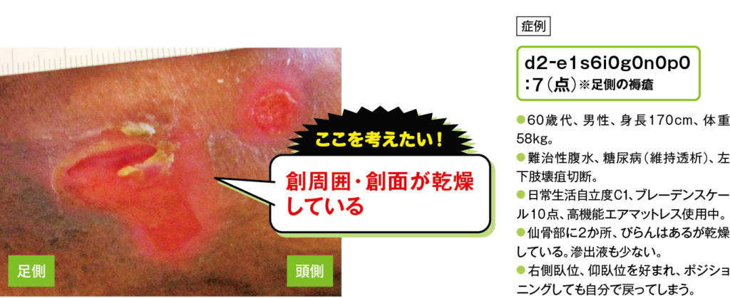 仙骨部d2褥瘡（ドライスキンの場合）の症例写真