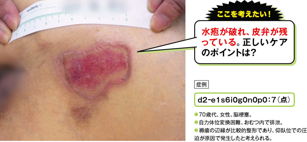 水疱が破れ皮弁がある場合の仙骨部d2褥瘡の症例写真