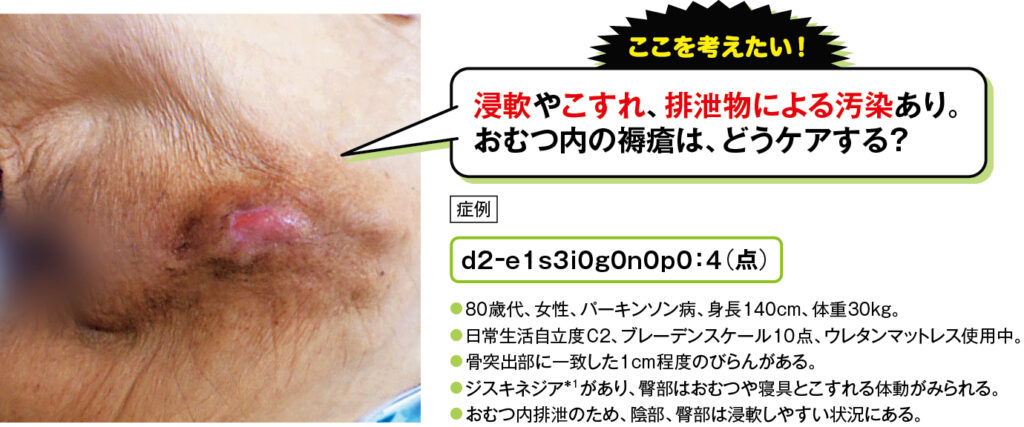 おむつ着用の場合の尾骨部d2褥瘡の症例写真