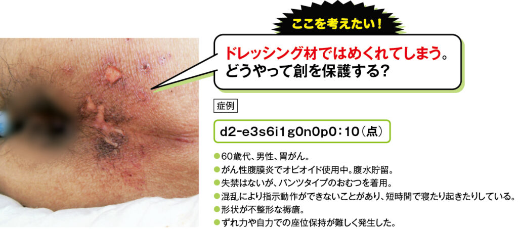 不安定な座位姿勢によるずれが原因の尾骨部d2褥瘡の症例写真