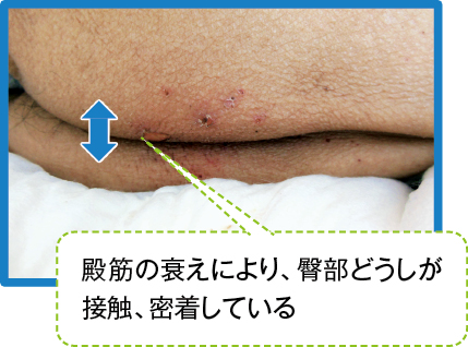 臀部どうしの擦れによる褥瘡の発生