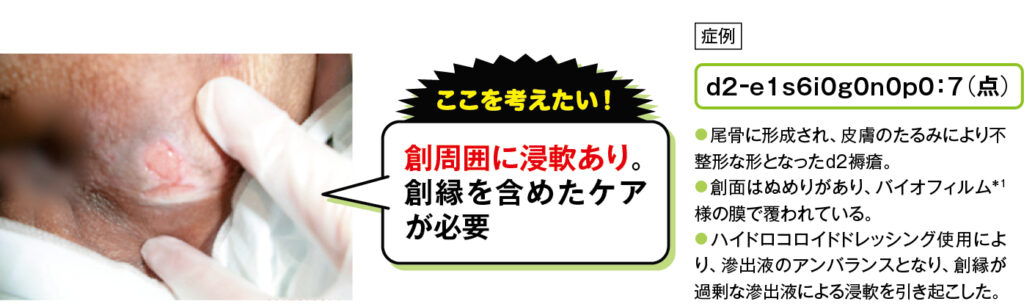 失禁により皮膚が浸軟した尾骨部d2褥瘡の症例写真