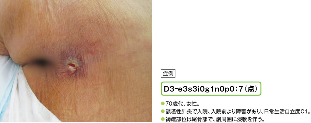 尾骨部のD3褥瘡の症例写真