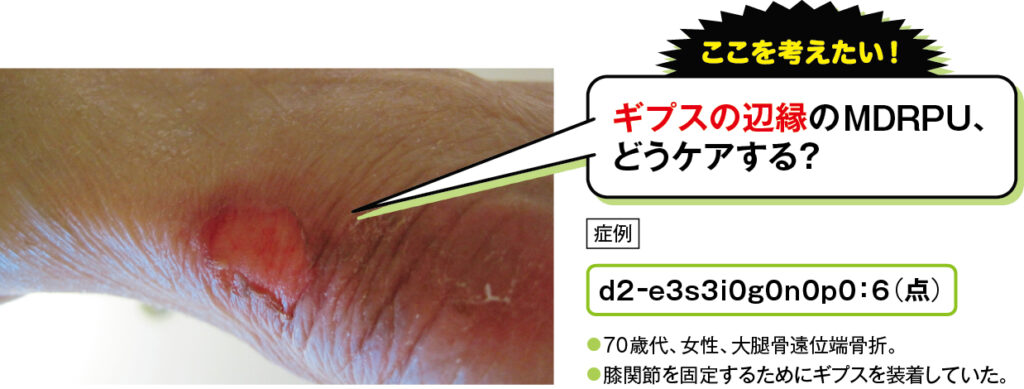 ギプス辺縁のMDRPUの場合のd2褥瘡の症例写真