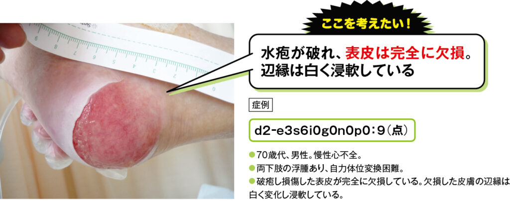 表皮が欠損した場合の踵部d2褥瘡の症例写真