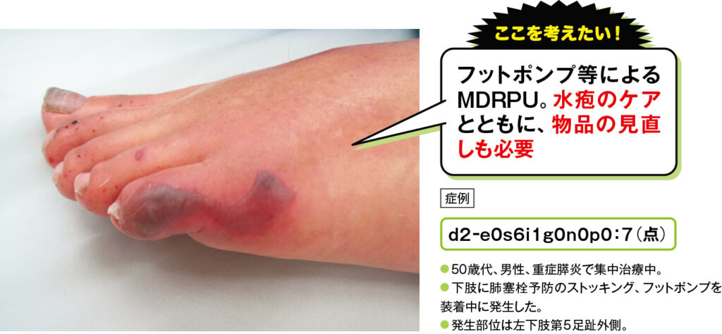 水疱があるMDRPUの場合の足趾のd2褥瘡の症例写真