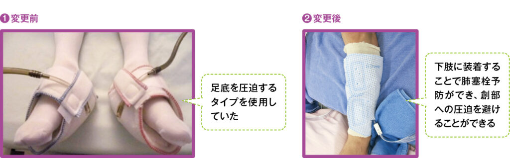 下肢用フットポンプのパットに変更した写真