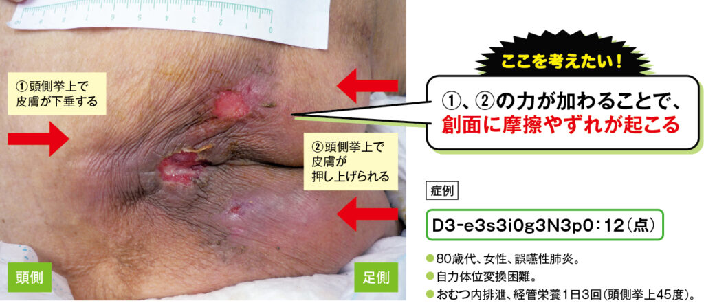尾骨部のd2、D3褥瘡の症例写真