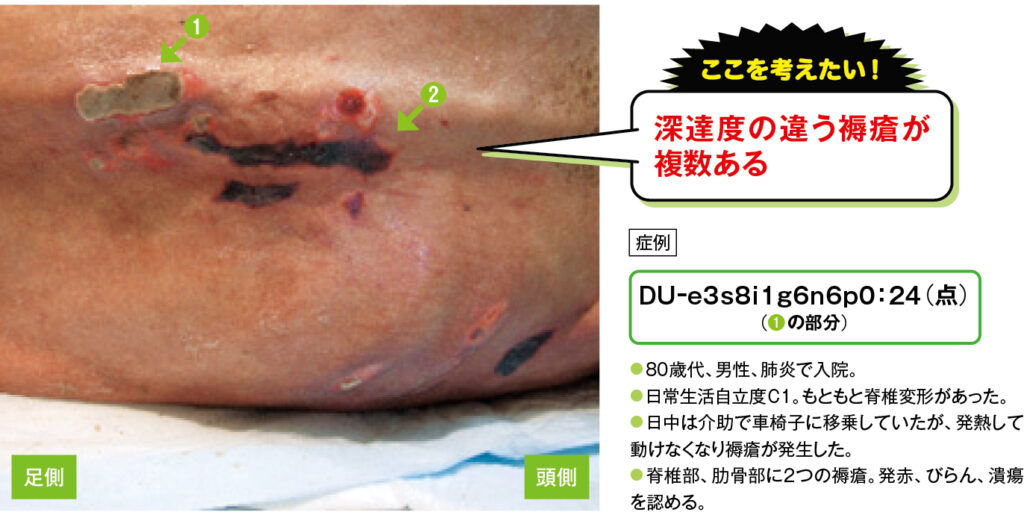 脊椎部と肋骨部の褥瘡の症例写真