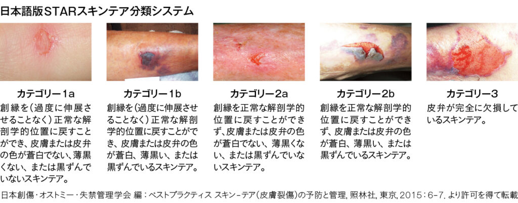 日本語版STARスキンケア分類システム