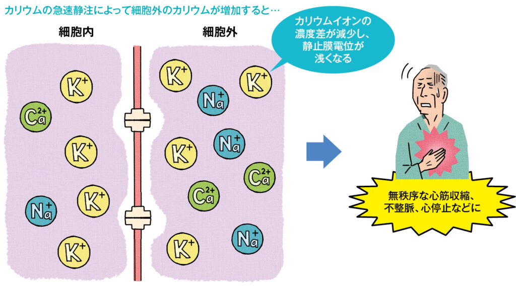 カリウムの急速静注射のリスク