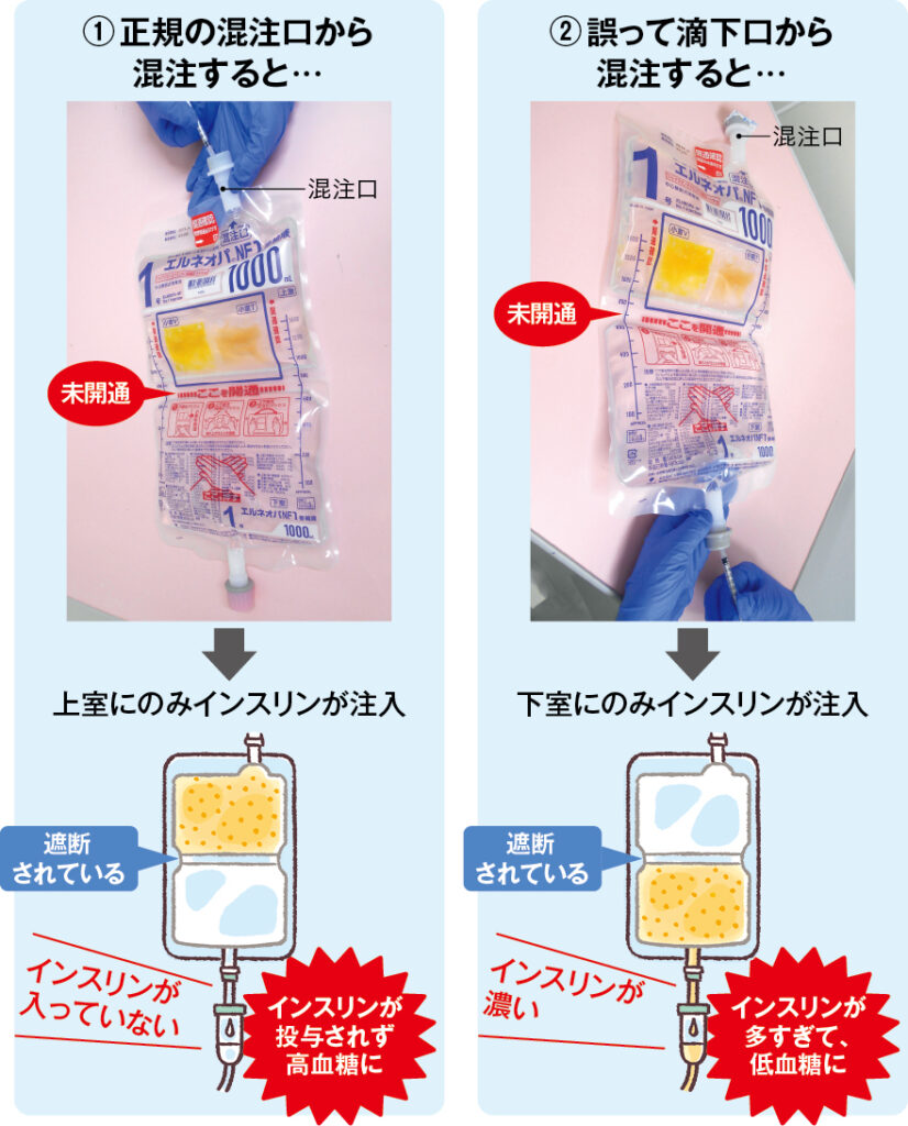 エルネオパ®を開通せずにインスリン製剤を混注した場合に生じうる事故