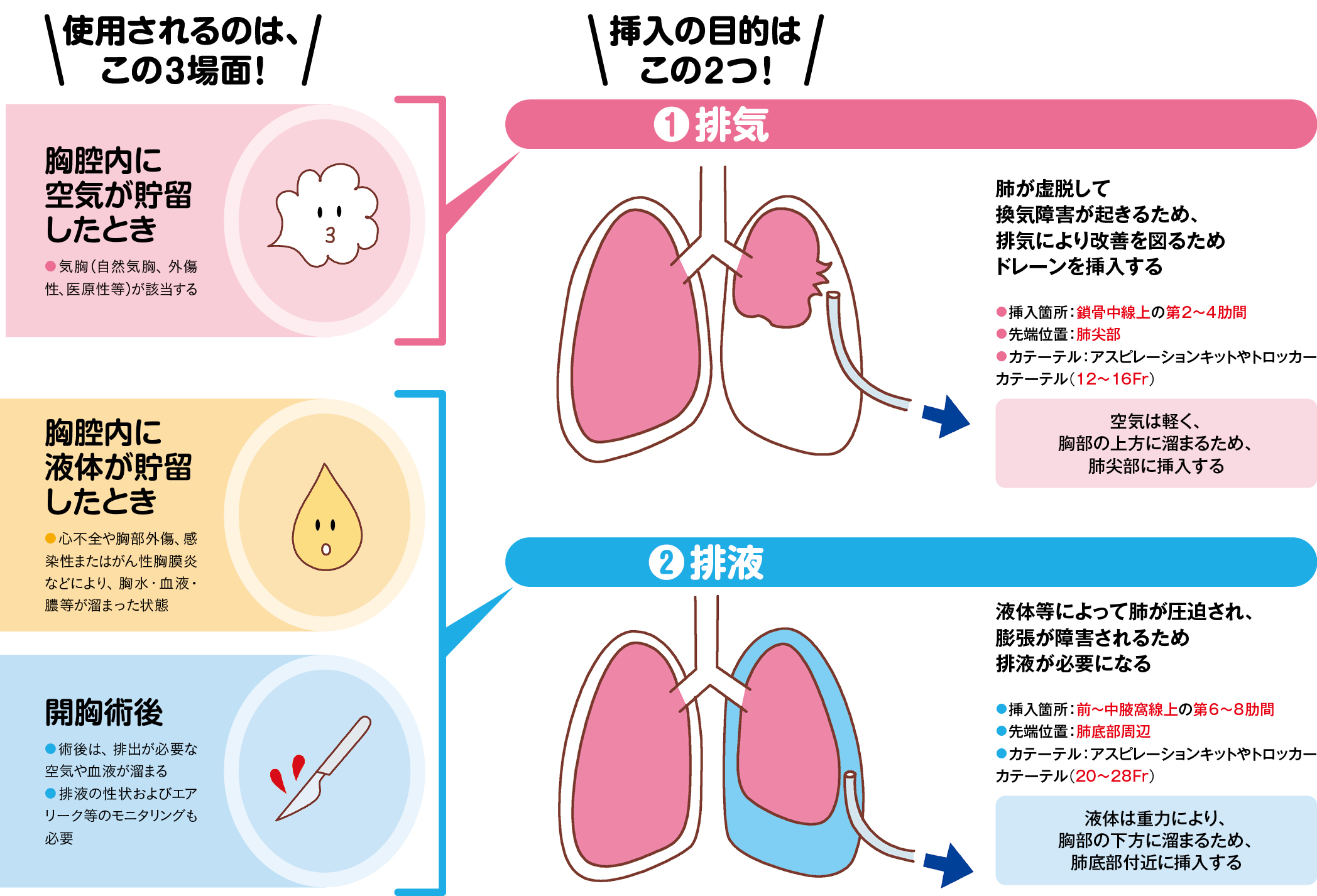 胸腔ドレーンを使用する場面と挿入の目的を説明するイラスト