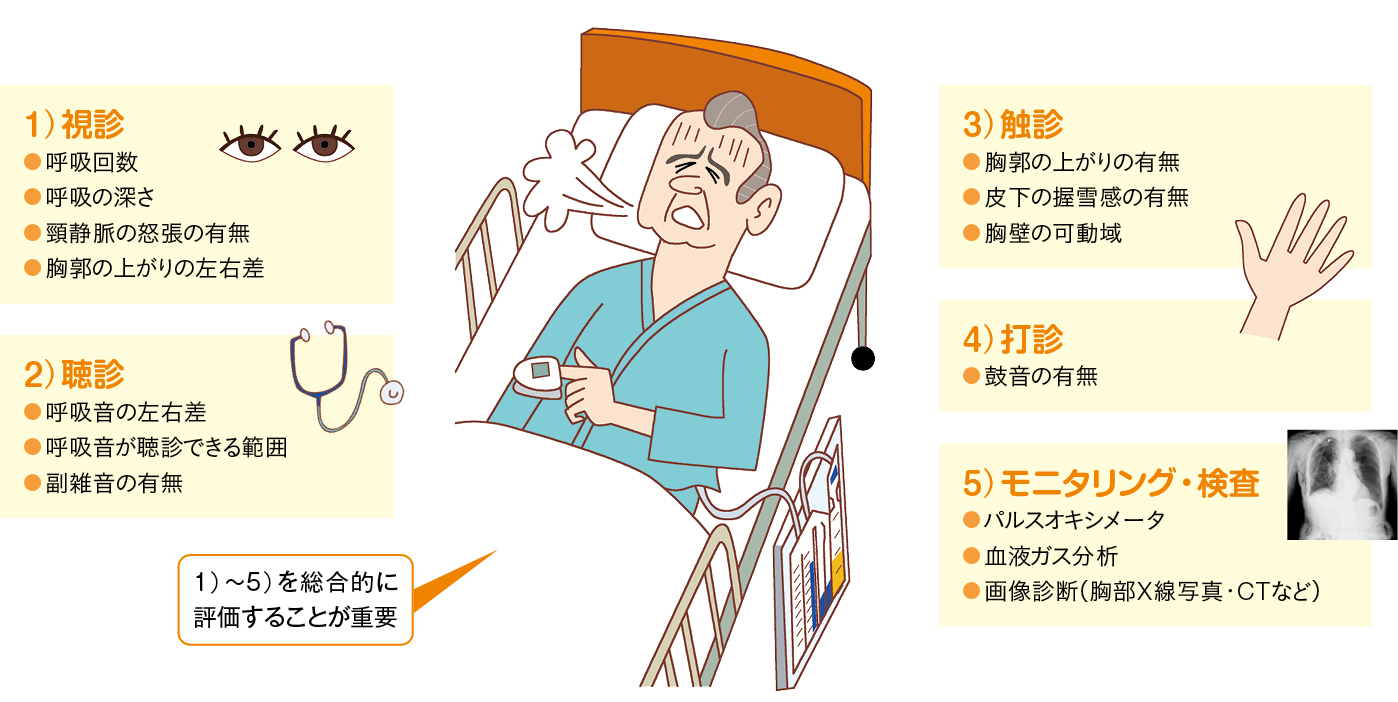 胸腔ドレナージ中の呼吸状態の観察ポイント