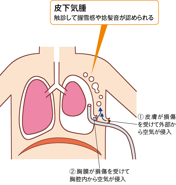 図1　皮下気腫の起こる原因（胸腔ドレーン留置による）