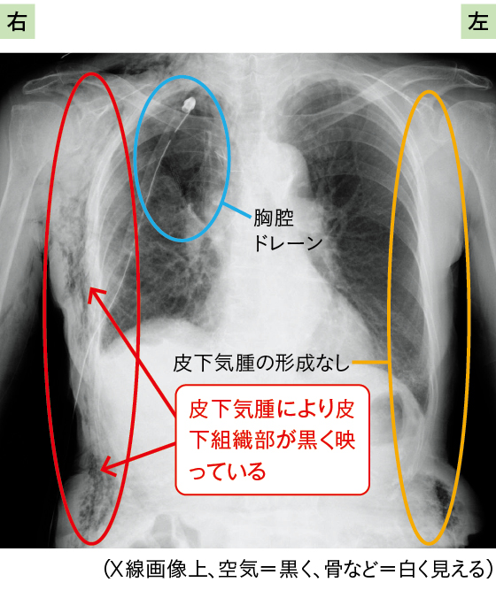 胸腔ドレナージ中の皮下気腫