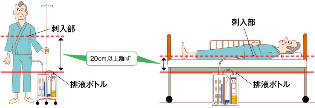 ドレーンルート・排液バッグの位置を解説するイラスト