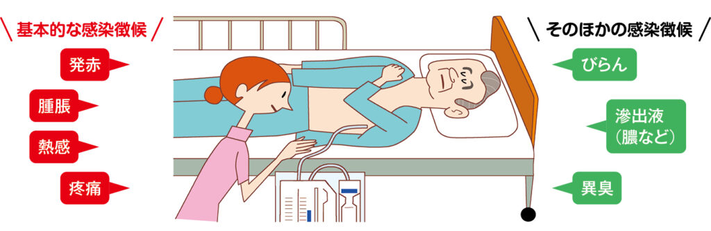 刺入部の感染徴候の観察ポイントのイラスト