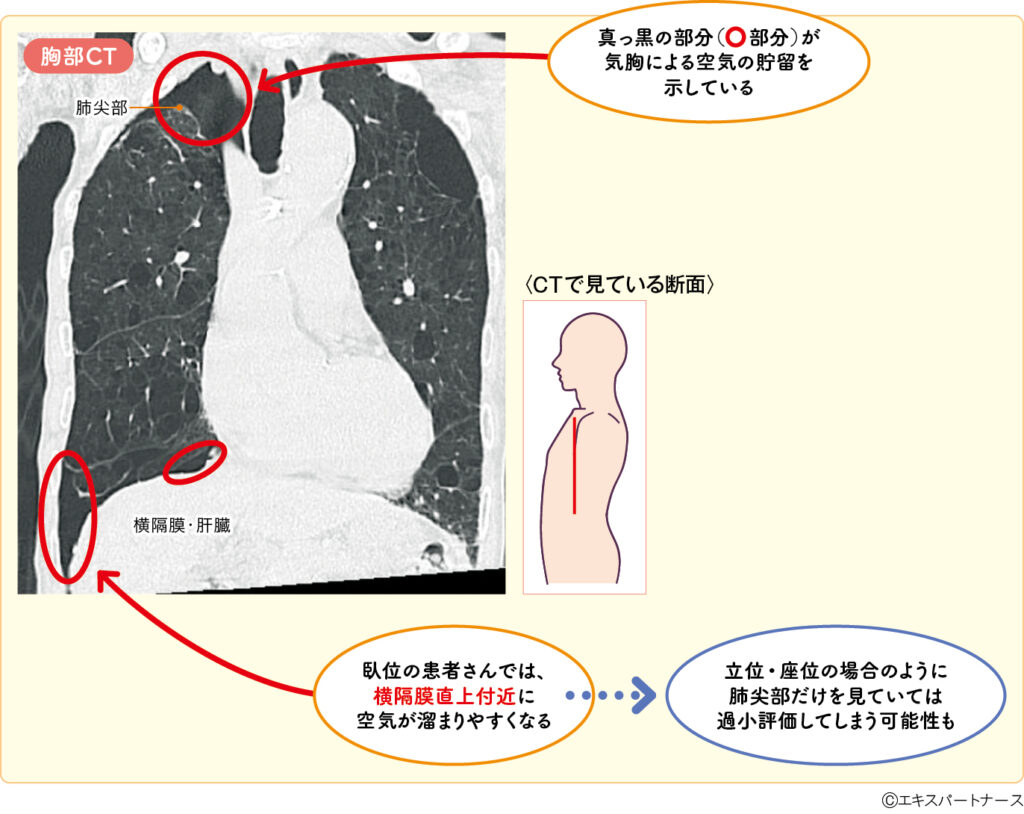 胸部X線による自然気胸の鑑別(臥位)#4 | エキスパートナースweb