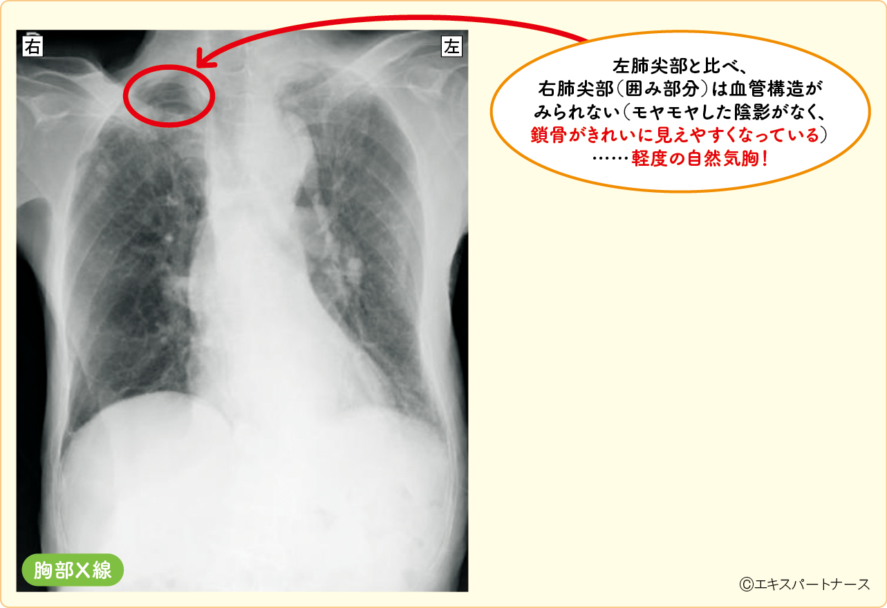 １度気胸の肺尖部（座位）