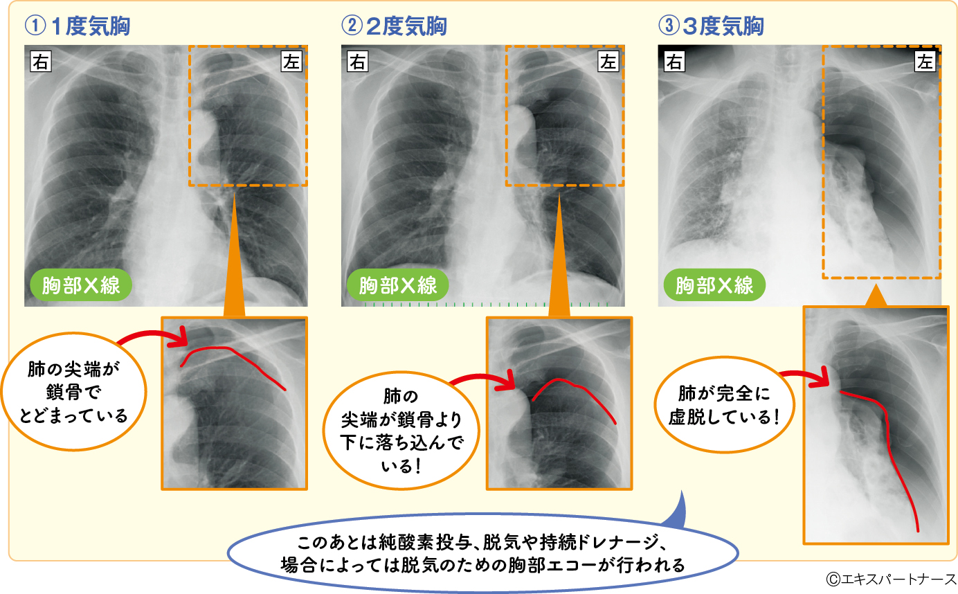 自然気胸の重症度別の肺虚脱所見