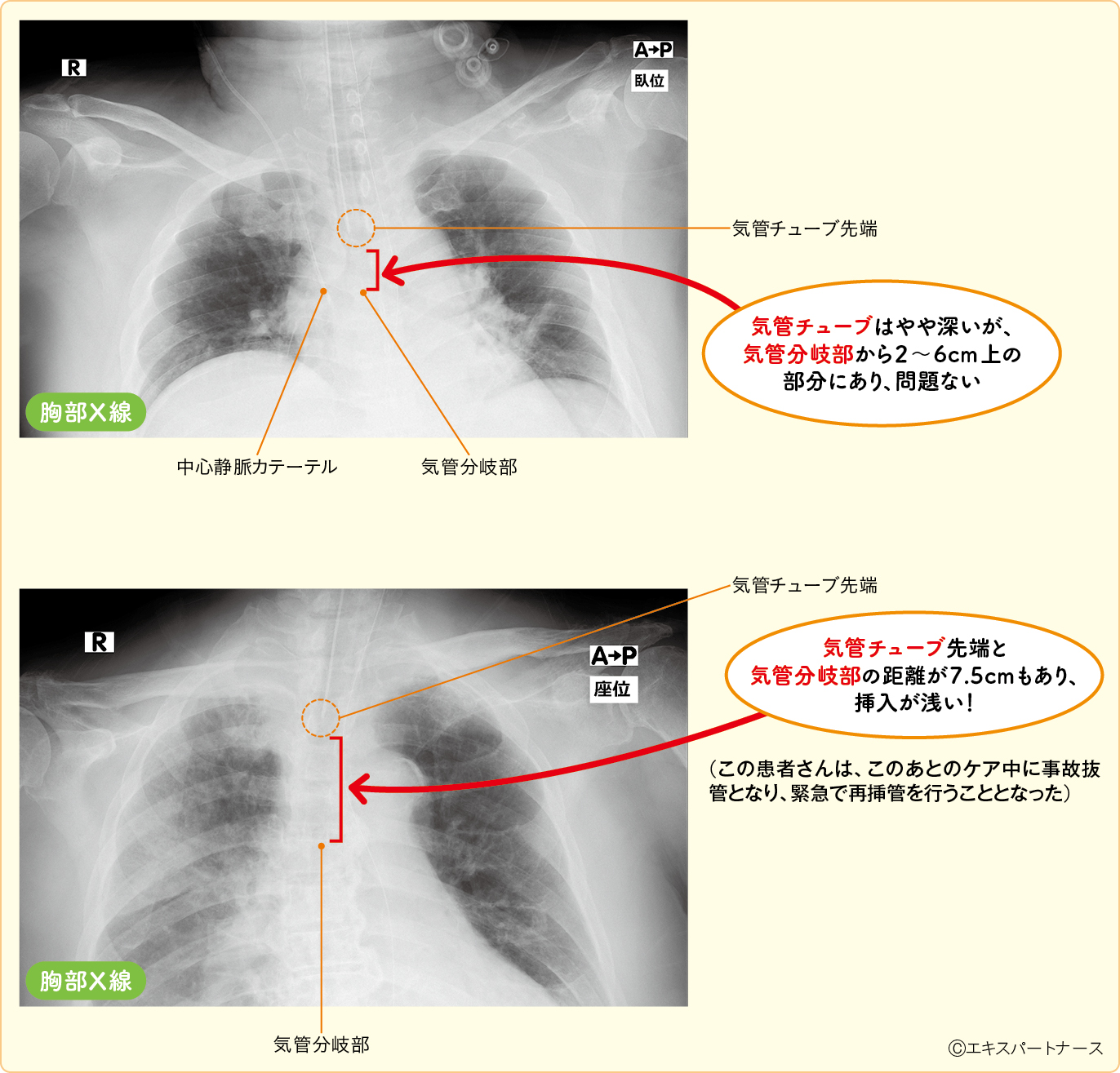 人工呼吸器装着患者の気管チューブの適切な深さと浅すぎる場合