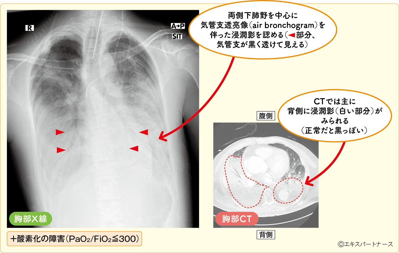 図1　肺炎球菌性肺炎からARDSへと進展した症例