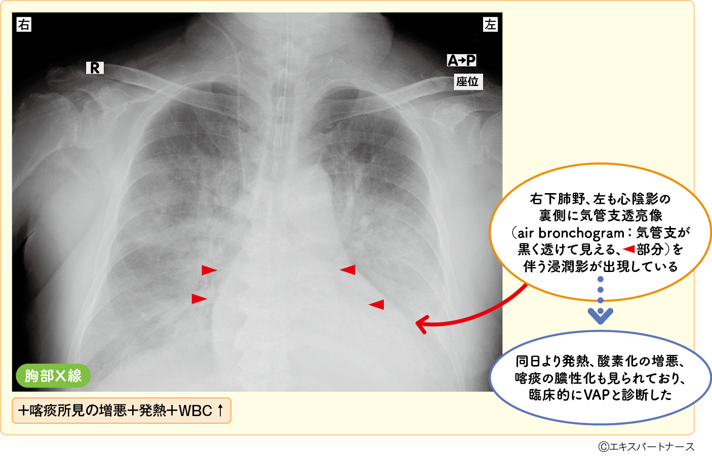 図1　心不全を治療中にVAPと診断した症例（人工呼吸器管理8日目）