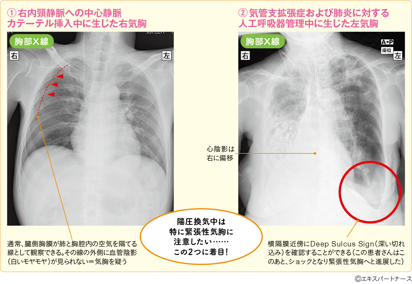 図1　気胸を生じた2症例の胸部X線画像