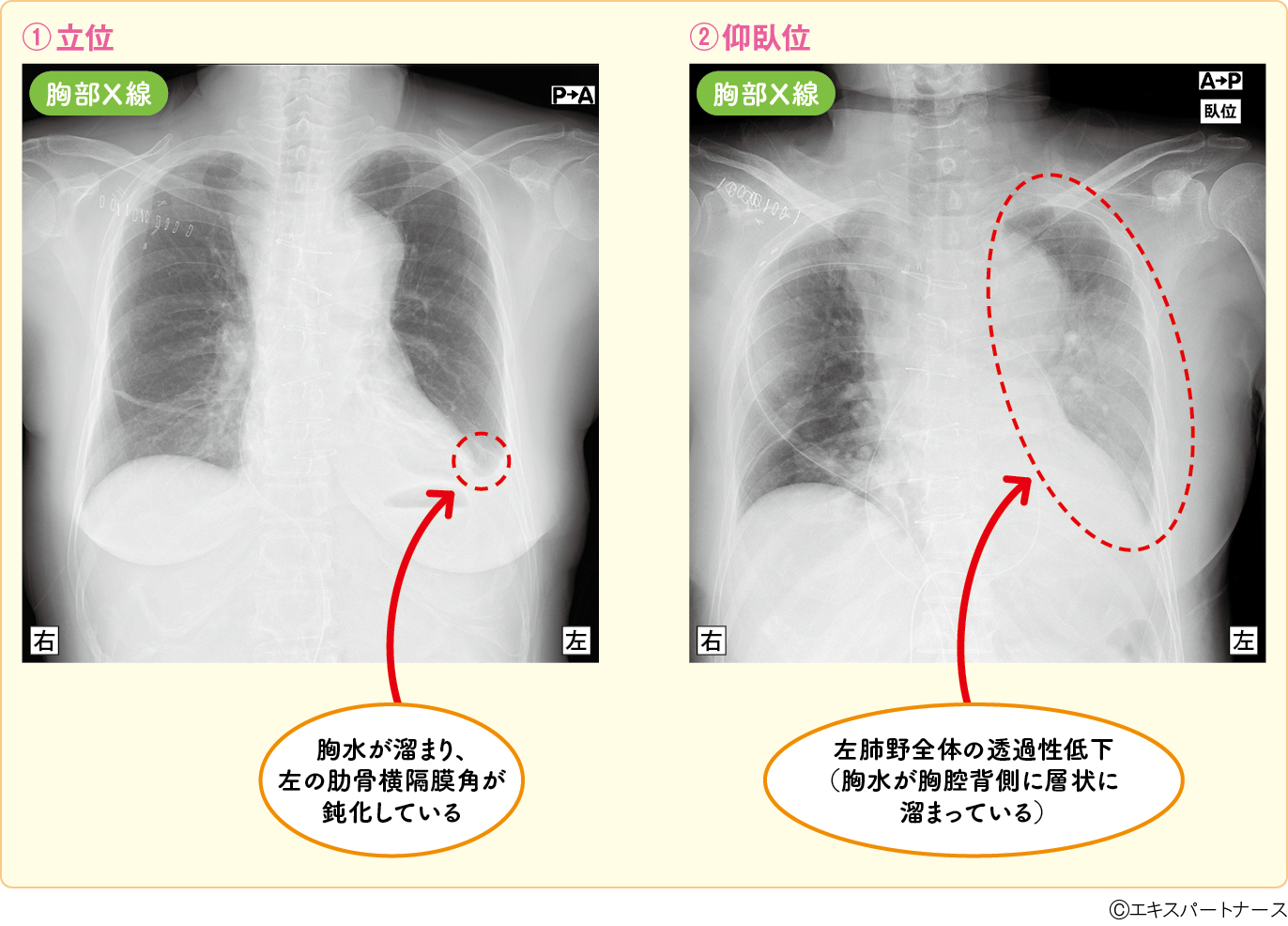 図1　左胸水を生じた症例の胸部X線画像