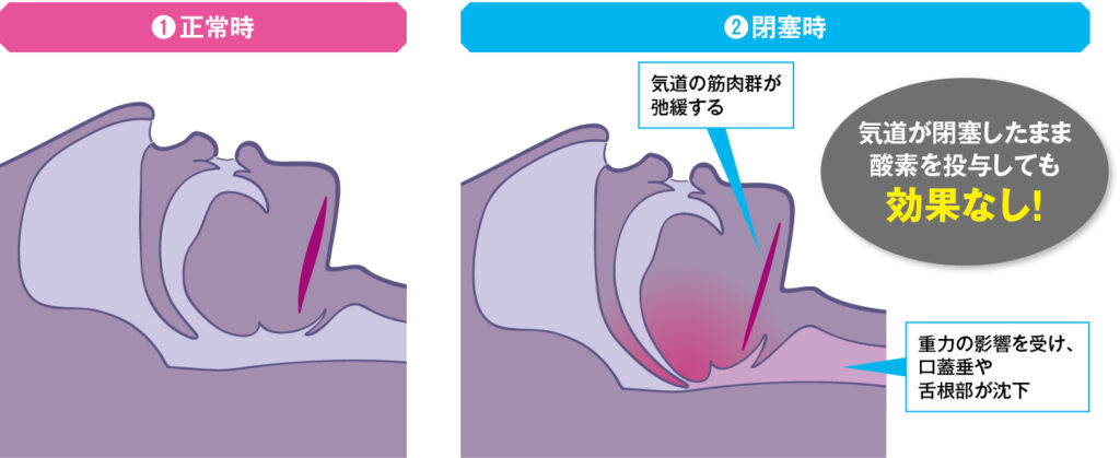 正常時と閉塞時の咽頭・喉頭の違い