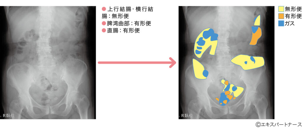 直腸性便秘症（図4パターン➂）
