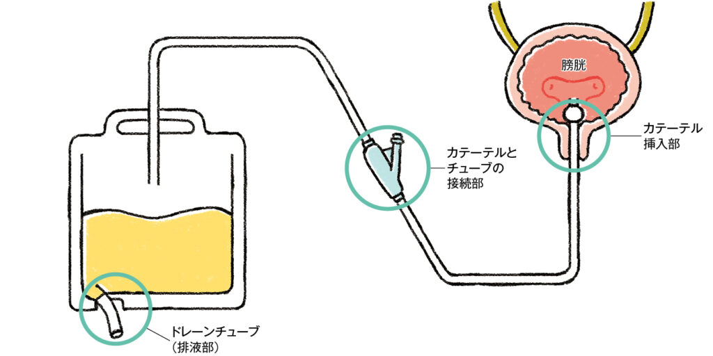 閉鎖式尿道留置カテーテルにおける感染経路のイラスト
