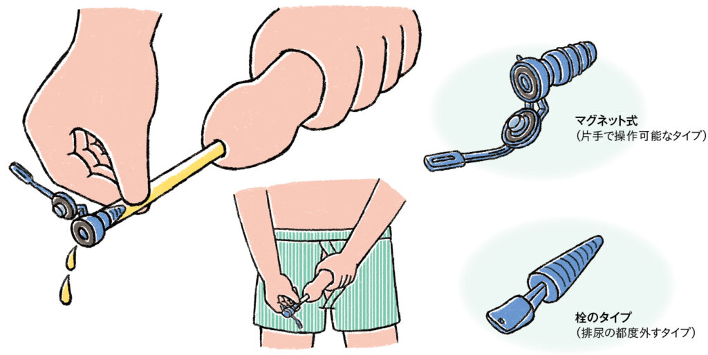 キャップ排尿の例のイラスト