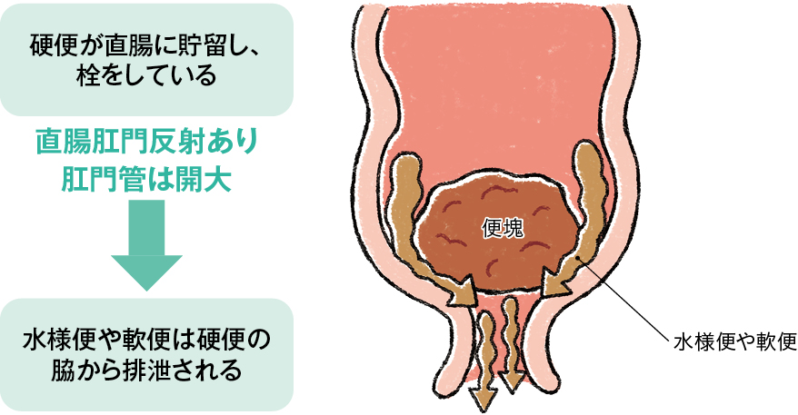 溢流性便失禁のしくみ