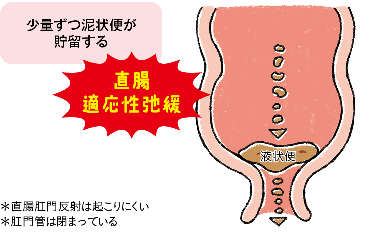漏出性便失禁のしくみ