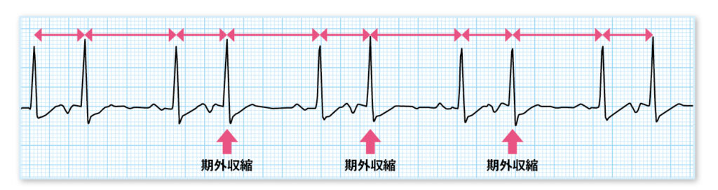 心房期外収縮(PAC)の心電図波形の読み方 | エキスパートナースweb