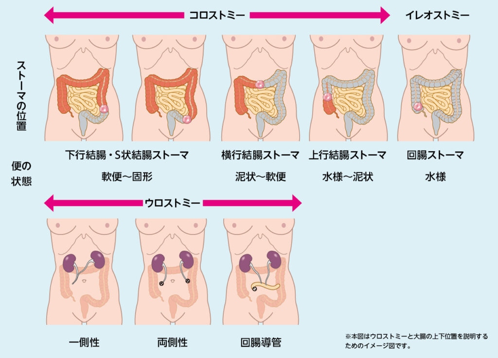 ストーマ造設の基本的な位置と便の状態