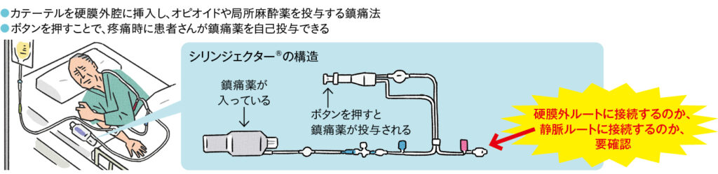 患者自己調節鎮痛法の説明イラスト