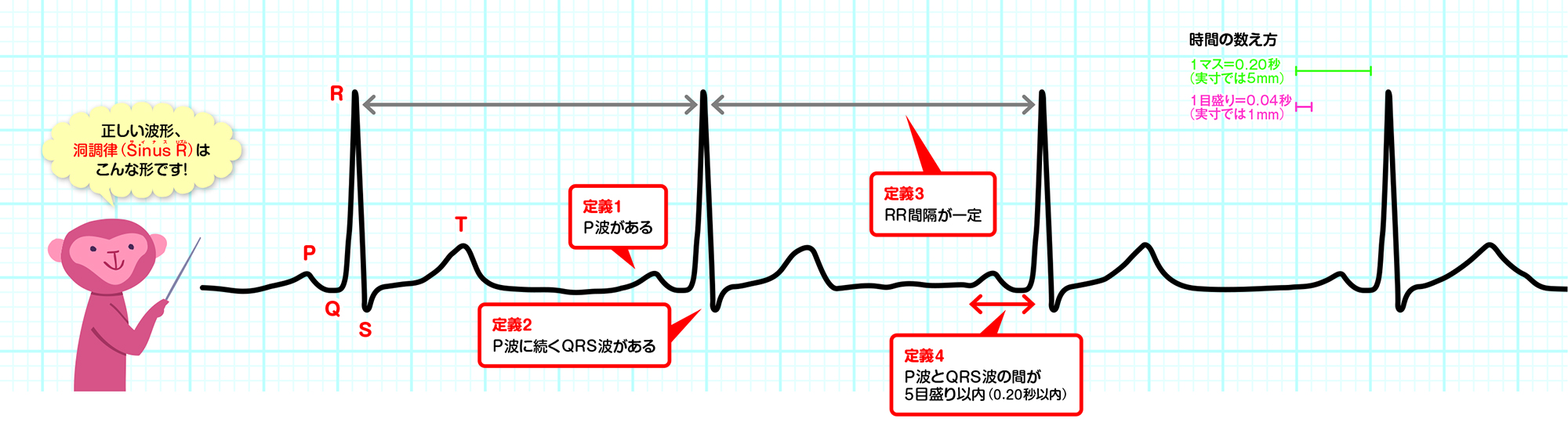 洞調律の波形