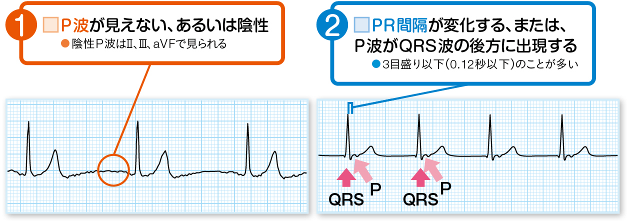 房室接合部調律の読み方