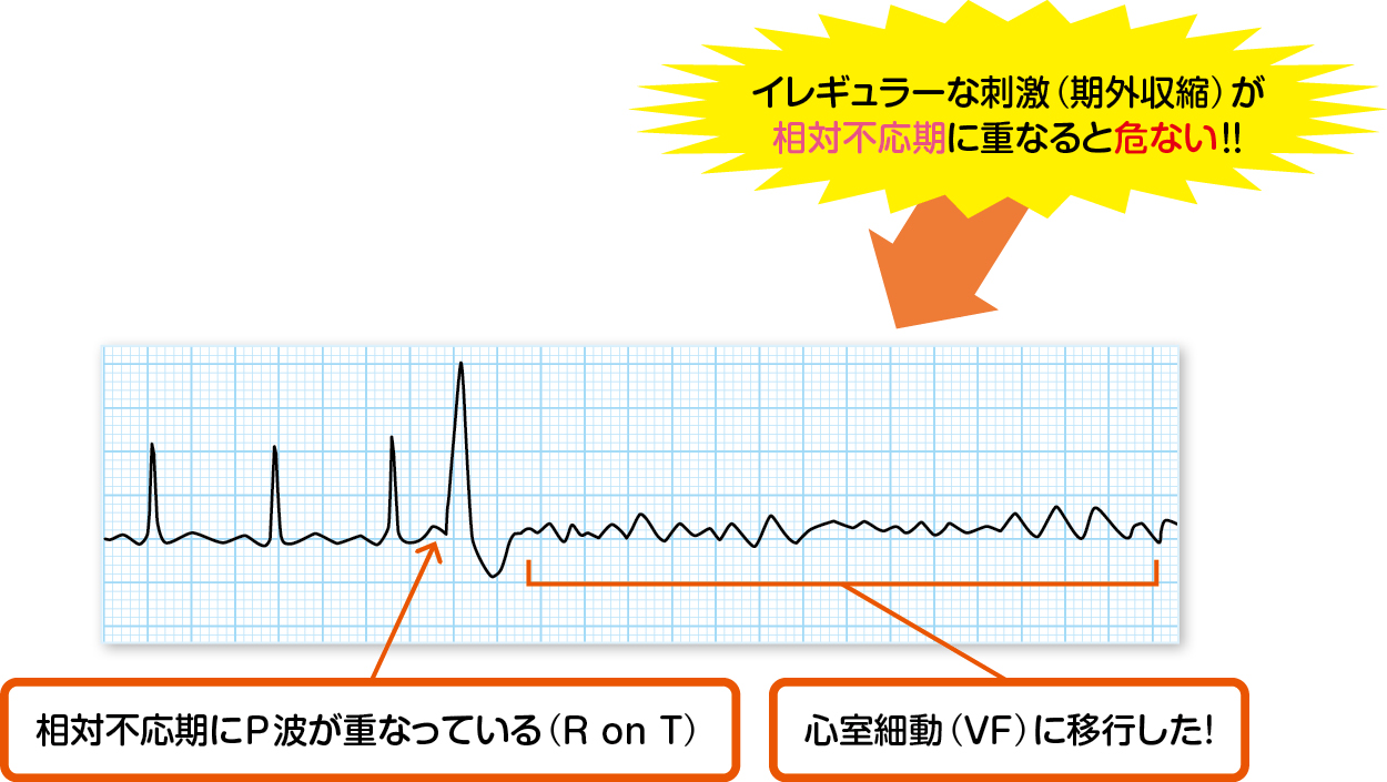 不規則な波形２